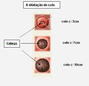Processo de dilatação do colo